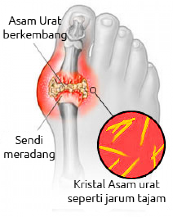 Dari Sulit Berjalan hingga Kembali Beraktivitas: Sebuah Pengalaman Menghadapi Asam Urat